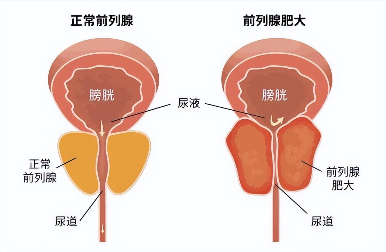 前列腺是男人的“生命腺”，有尿频尿急就得赶快治