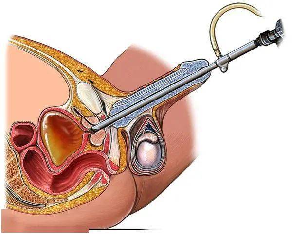 如何预防前列腺手术所导致的尿失禁？